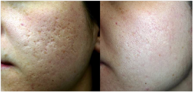 pimples-scar-reduction